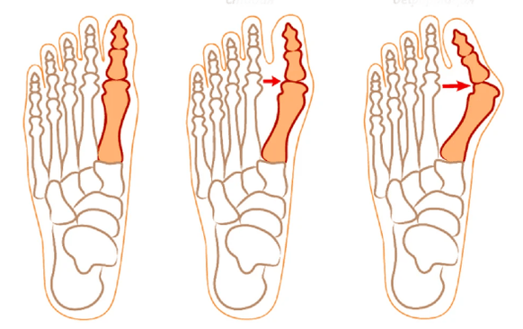 Deformita Hallux Valgus