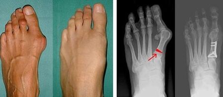 příznaky hallux valgus