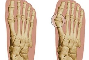 příčiny hallux valgus
