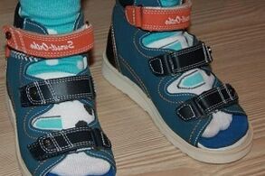 nošení sandálů pro hallux valgus u dítěte