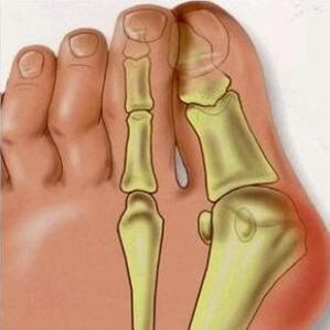 Důvody pro Valgus