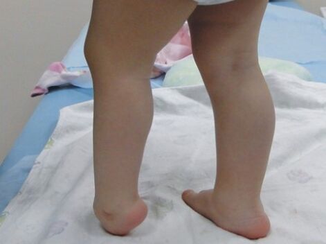 První příznaky deformace nohy Valgus