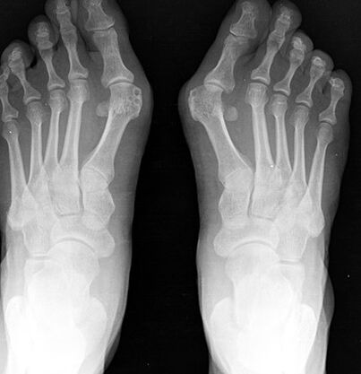 X -ray nohy